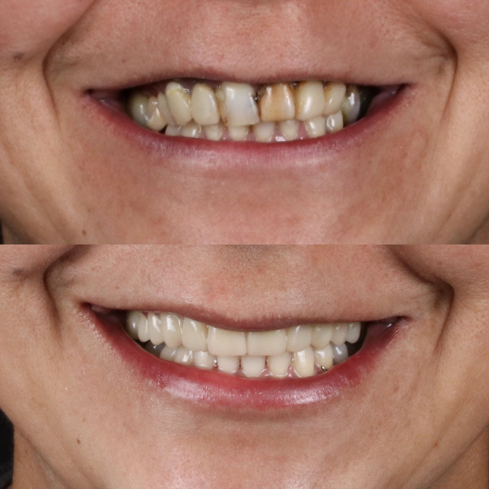 Rehabilitación adhesiva